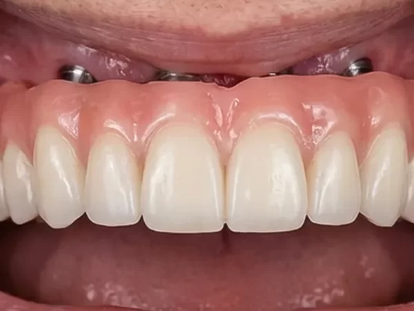 Dentures or All-on-4 Solutions