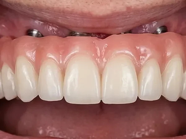 Dentures or All-on-4 Solutions