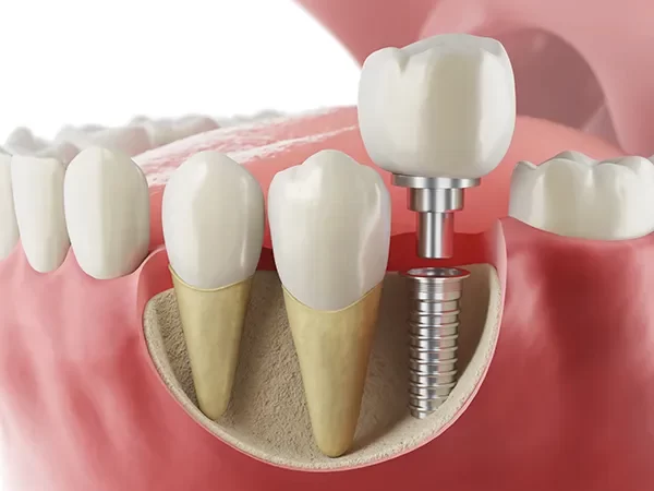 Implants or Implant-Supported Restorations