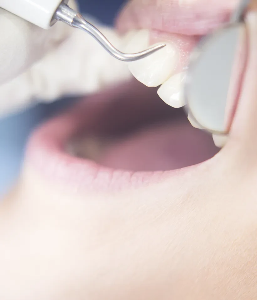 Gum Disease Treatment