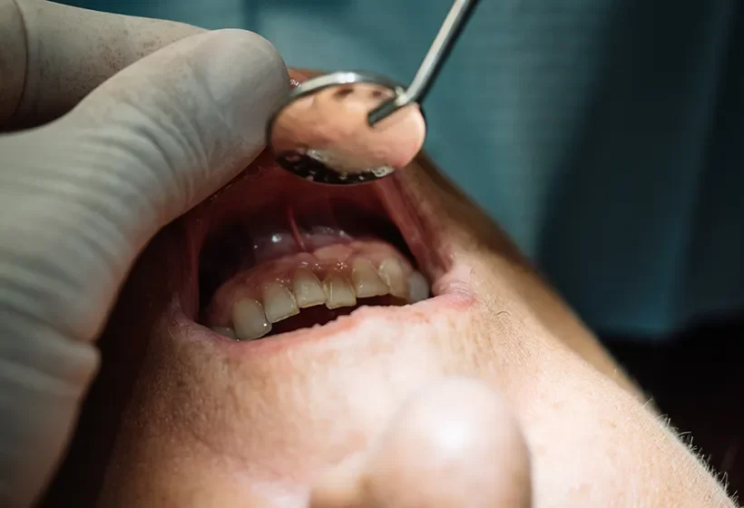 Gum Disease Treatment