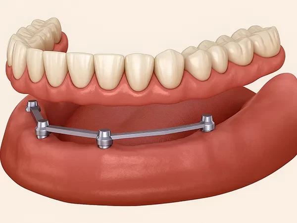 Implant-Supported Dentures