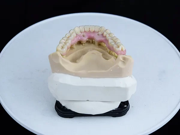 Fixed Implant-Supported Dentures