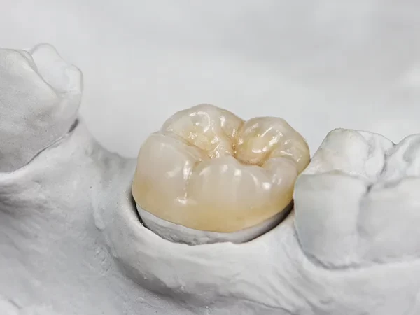 Porcelain Inlays and Onlays