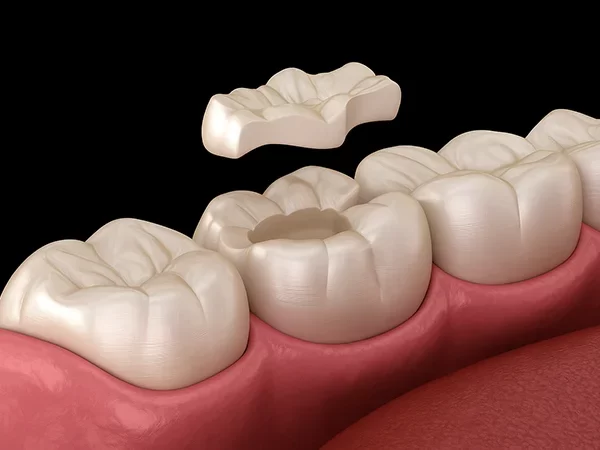 Composite Resin Inlays & Onlays