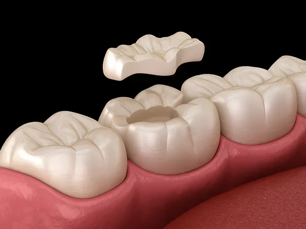Composite Resin Inlays & Onlays