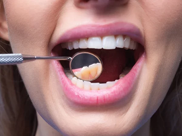 Oral Cancer Screening