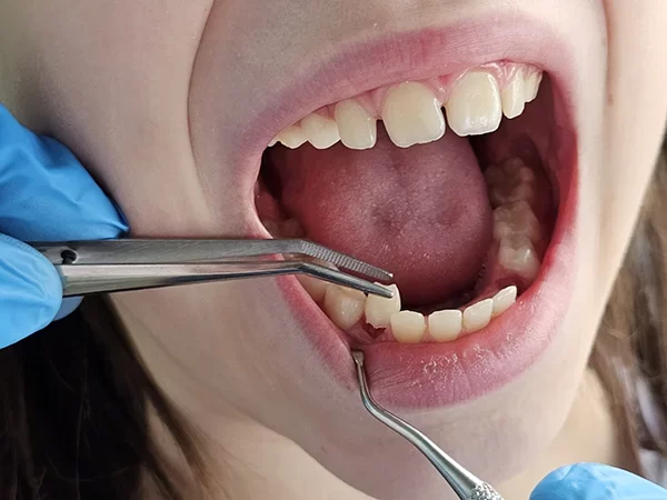 Restorative Pediatric Treatments