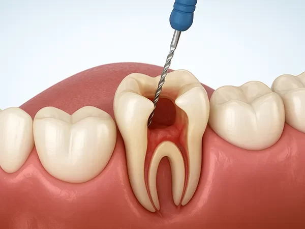 Root Canal Therapy