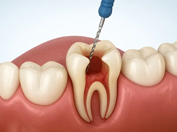 Root Canal Therapy
