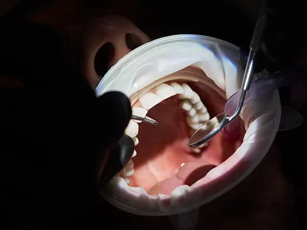 Premolar Root Canal Therapy