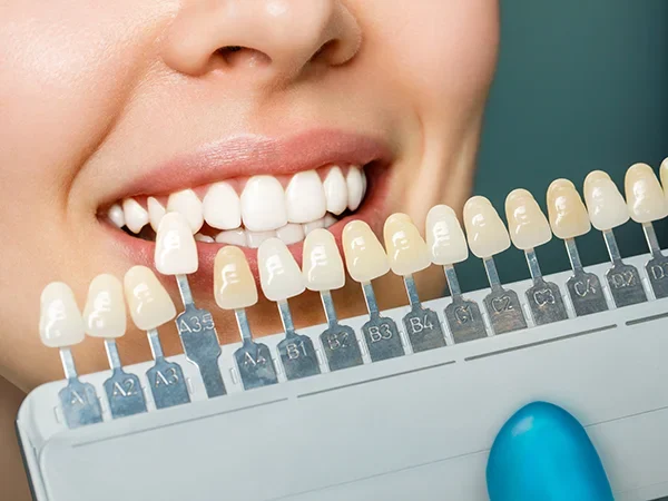 Dental Veneer-Based Makeovers