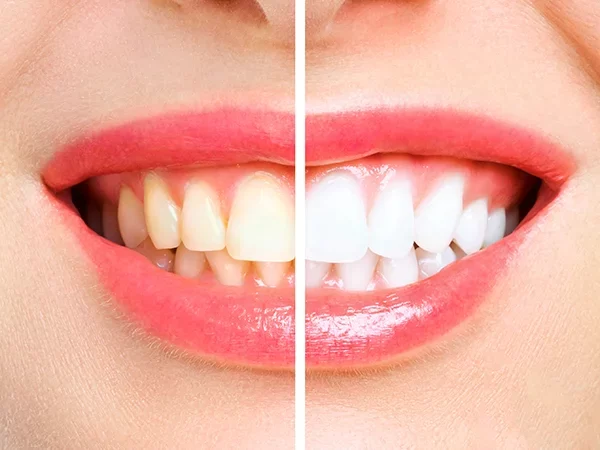 Teeth Whitening