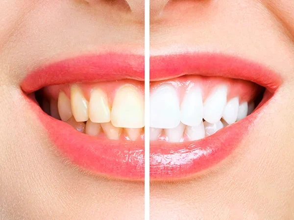 Teeth Whitening