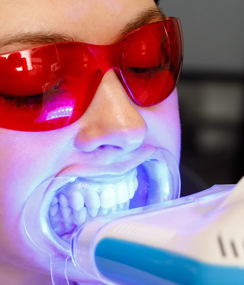 Teeth Whitening
