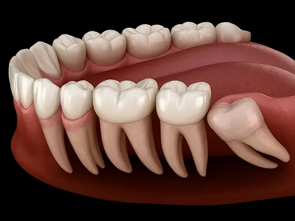Wisdom Teeth Removal