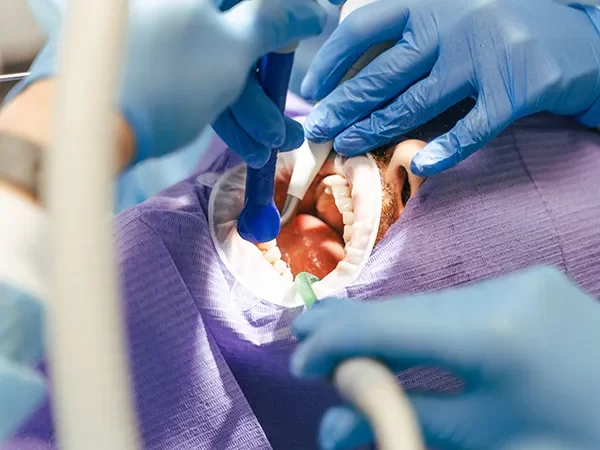 Surgical Wisdom Teeth Removal